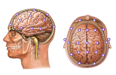 Electrode placement for measuring visual evoked potentials (VEP).